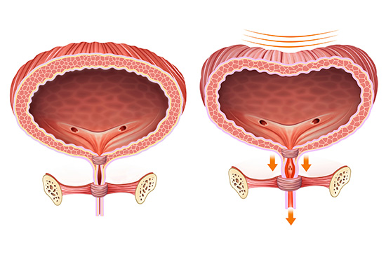 continence Foundation Ireland physiotherapy bladder control photo 