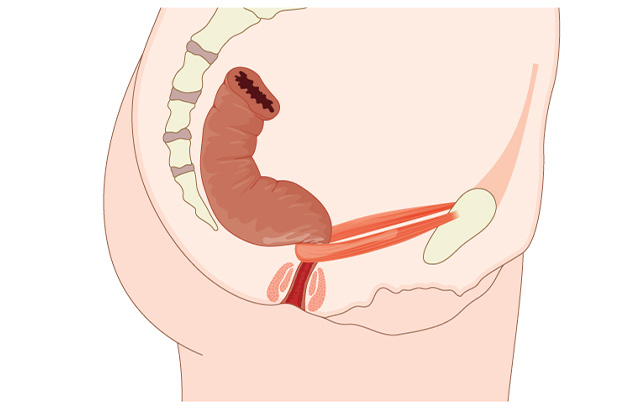 continence Foundation Ireland Bowel Control illustration